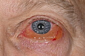 Conjunctival oedema in a man's eye