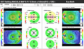 Retinal thickness maps of healthy eyes, OCT scan
