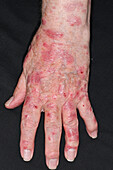 Psoriasis on a man's hand