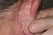 Psoriasis behind a man's ear