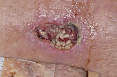 Maggots in leg ulcer in female patient