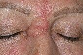 Scar post basal cell carcinoma excision