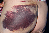 Bruising on a woman's buttocks