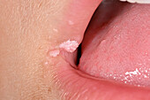 Wart on a girls mouth