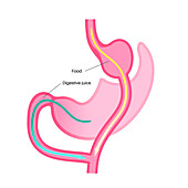 Gastric bypass surgery, illustration