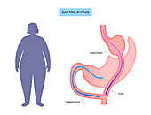 Gastric bypass surgery, illustration