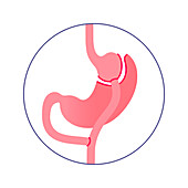 Gastric bypass surgery, illustration