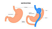 Gastric bypass surgery, illustration