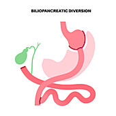 Biliopancreatic diversion procedure, illustration