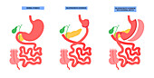 Biliopancreatic diversion procedure, illustration