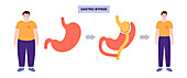 Gastric bypass surgery, illustration