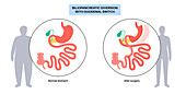 Biliopancreatic diversion procedure, illustration