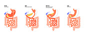 Types of bariatric surgery, illustration