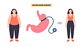 Gastric band medical procedure, illustration