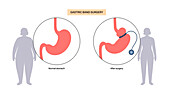 Gastric band medical procedure, illustration