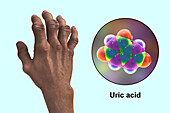 Gout-afflicted hands with deformities, illustration