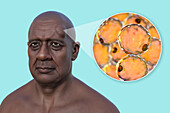 Lipoma on a man's forehead, illustration