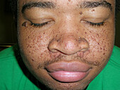 Skin lesions in tuberous sclerosis