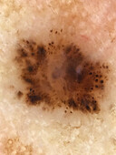 Pigmented basal cell carcinoma, dermoscopy