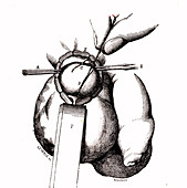 Varicocele surgery, 19th century illustration
