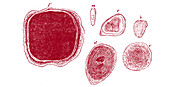 Prostate corpora amylacea, illustration
