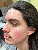 Acne after treatment