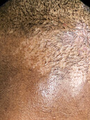 Seborrheic dermatitis and alopecia