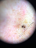 Pigmented basal cell carcinoma, dermoscopy