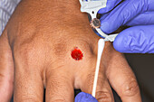 Shave biopsy of a melanoma
