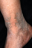 Terra-firma forme dermatosis