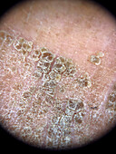 Terra-firma forme dermatosis, dermoscopy