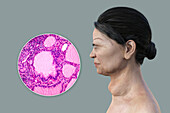 Graves' disease, 3D illustration