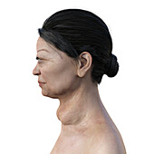 Graves' disease, 3D illustration