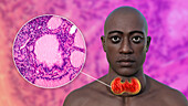 Enlarged thyroid gland, 3D illustration