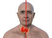 Enlarged thyroid gland and protruding eyes, 3D illustration