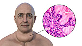 Enlarged thyroid gland and protruding eyes, 3D illustration