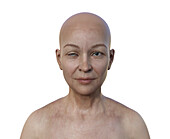 Woman with Horner syndrome, illustration
