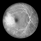 Retina affected by blastomycosis, illustration