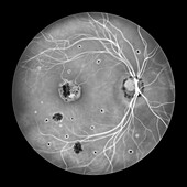 Retina affected by ocular histoplasmosis syndrome, illustration