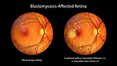 Retina affected by blastomycosis, illustration