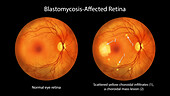 Retina affected by blastomycosis, illustration