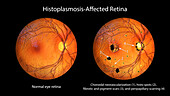 Retina affected by ocular histoplasmosis syndrome, illustration