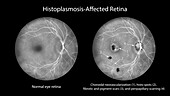 Retina affected by ocular histoplasmosis syndrome, illustration