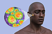 Middle ear infection, 3D illustration