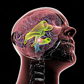 Brain tumour causing hydrocephalus, illustration