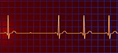 ECG with second degree Mobitz 2 AV block, illustration
