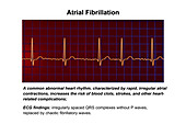 ECG in atrial fibrillation, illustration