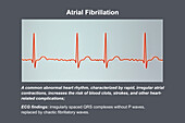 ECG in atrial fibrillation, illustration