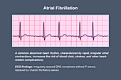 ECG in atrial fibrillation, illustration