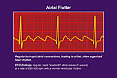 ECG in atrial flutter, illustration